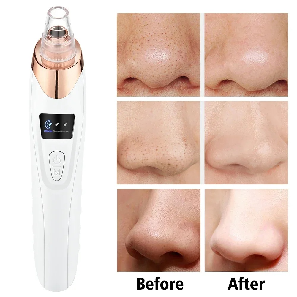 Derma Suction – Blackhead Remover & Pore Vacuum Cleaner