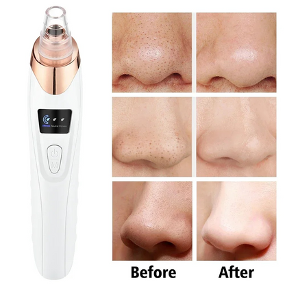 Derma Suction – Blackhead Remover & Pore Vacuum Cleaner
