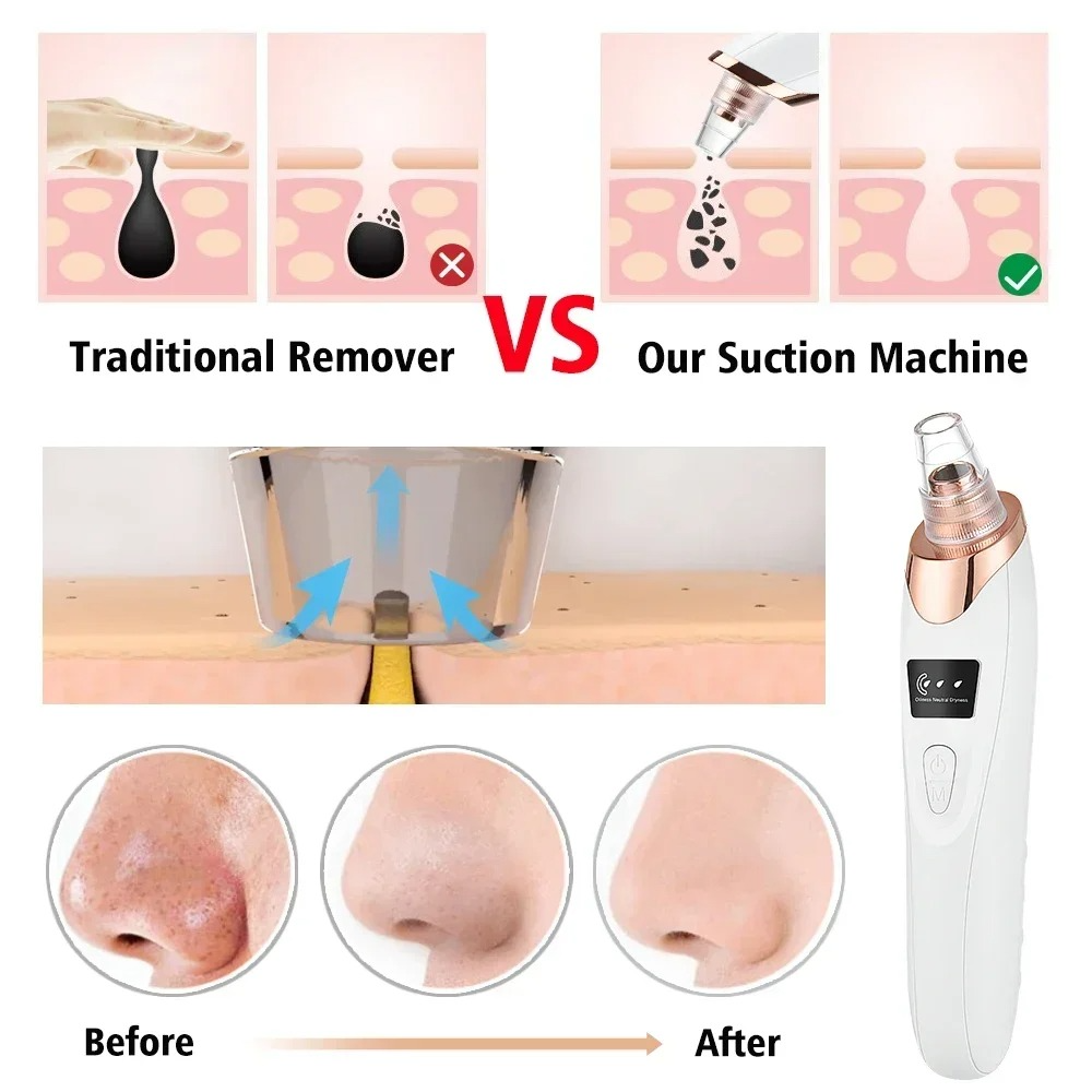 Derma Suction – Blackhead Remover & Pore Vacuum Cleaner
