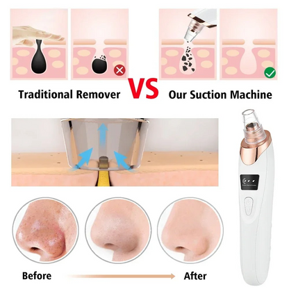 Derma Suction – Blackhead Remover & Pore Vacuum Cleaner