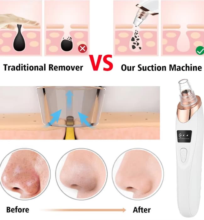 Derma Suction Blackhead Remover & Pore Vacuum Cleaner